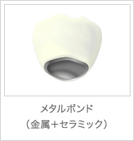 メタルボンド(金属+セラミック)