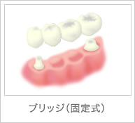 ブリッジ(固定式)