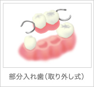 部分入れ歯(取り外し式)