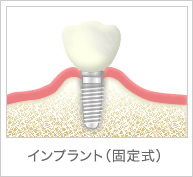 インプラント（固定式）