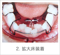 2. 拡大床装着