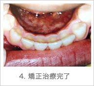 4. 矯正治療完了