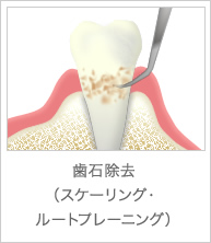 歯石除去（スケーリング・ルートプレーニング）